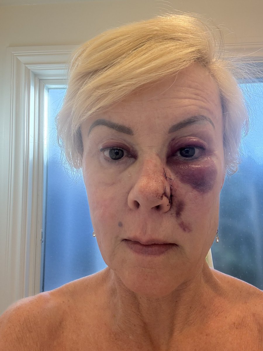 PaulaMaier3's tweet image. Skin cancer is NO JOKE!
The swelling will last at least 30 days ☹️

#SkinCancer #Skincare  #Mohs