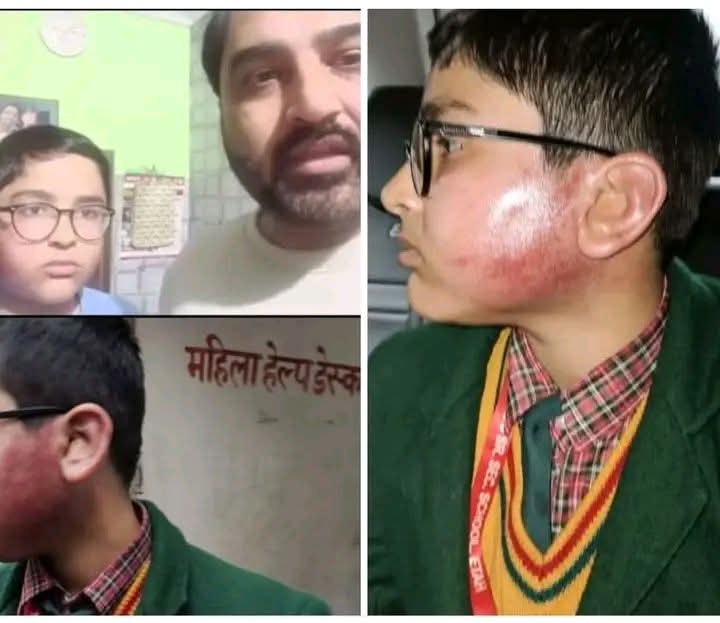 ऐसे शिक्षक समाज में कलंक है 

ये रोहित यादव हैं जो एटा निवासी हैं! इनके बेटे की उम्र महज 10 साल है जो एटा के सबसे महंगे सेंट पोल्स स्कूल में कक्षा 6 का छात्र है!

इस बच्चे को टीचर विजेंद्र चौहान ने इतना मारा कि इसके कान के पर्दे ही फट गए ! पूरे दिन क्लास से बाहर खड़ा रखा ! छुट्टी