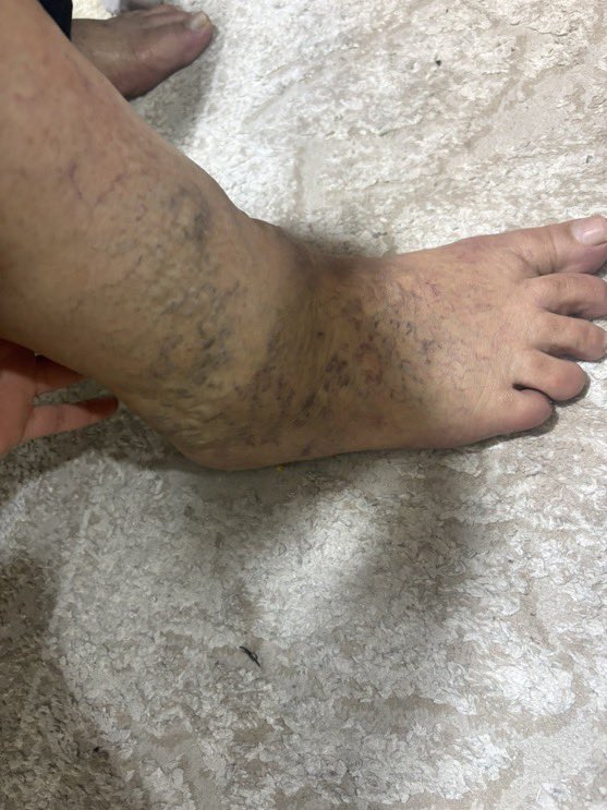 Simsim_o4's tweet image. The surgery is on Feb 6th so we have less than a week to raise the full amount🥲
Please if you can help in any way it would truly mean a lot 🩷
chuffed.org/project/163598…