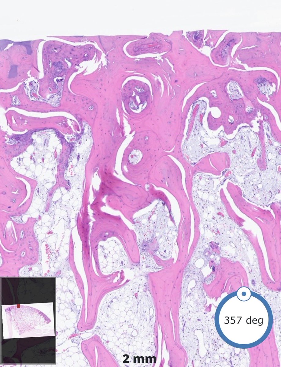 DrBuiPathology's tweet image. #DrBuiBoneCaseCollection 🌼Eburnation in osteoarthritis - The conversion of subchondral bone into a dense, polished, ivory-like surface caused by severe, chronic cartilage loss and direct bone-on-bone friction. ⁦@MoffittNews⁩ ⁦@USFpathology⁩ ⁦@CAPA_comm⁩ #PathX