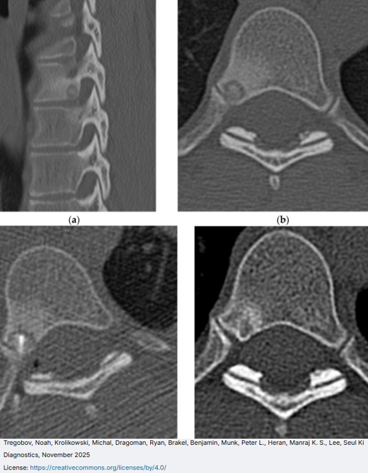 RadiologyArticl's tweet photo. 🩻 Osteoid osteoma ablation
Image-guided treatment pearls with curated FOAMed resources.
🔗 https://t.co/CO3IKccWDm
📸 Tregobov et al., Diagnostics (2025), CC BY 4.0
#FOAMIR #InterventionalRadiology #OsteoidOsteoma #BoneAblation https://t.co/SwVKZ0Cqvn