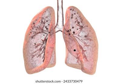 ISTHMECORINTHE's tweet image. Faut arrêter les conneries!
Tous ceux qui travaillaient dans les mines de charbon du Nord possèdent à la place des poumons,des éponges chargées de #silicose,cette pharmacienne,peut-elle les guérir au lieu de répandre des conneries à tout bout de champ!?
Le raciste patriote!
@UN