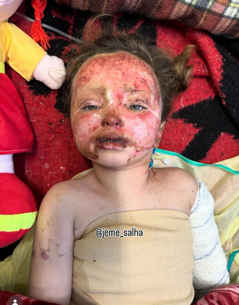 🚨HORRIBLE: A Palestinian baby injured by a bomb dropped from an Israeli quadcopter over Gaza.

The case was documented by Dr. Jamal Salha inside the Strip.