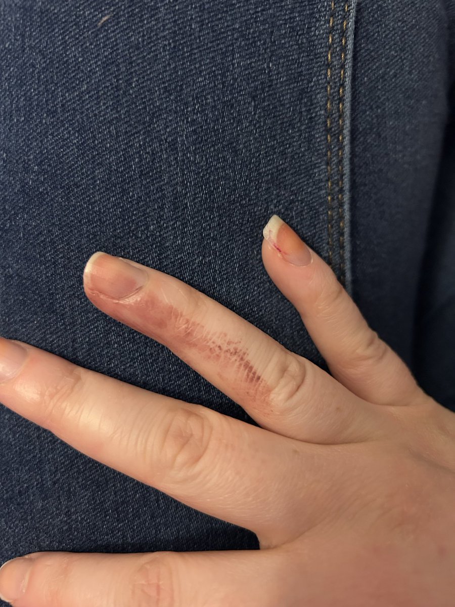 JenL1997's tweet photo. Had another mishap with the nail polish and my finger now looks like it’s severely bruised 🙃 No amount of remover or soap is taking it off either so I guess this is me for the foreseeable 🫠 https://t.co/xjHt8epWC2