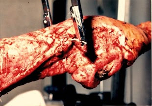 I'm on a Journey To Walk Again after 30 yrs. Excruciating Phantom Limb Pain. I'm crying out because I'm in Agony. Dragged down I-75 age 13. 70+ Surg,, 15 broken bones, 4 months in traction/Burn Unit. 15 years later Above Knee Amp. Recent Broken Back.Ty🩷 
gofund.me/af7e61f64