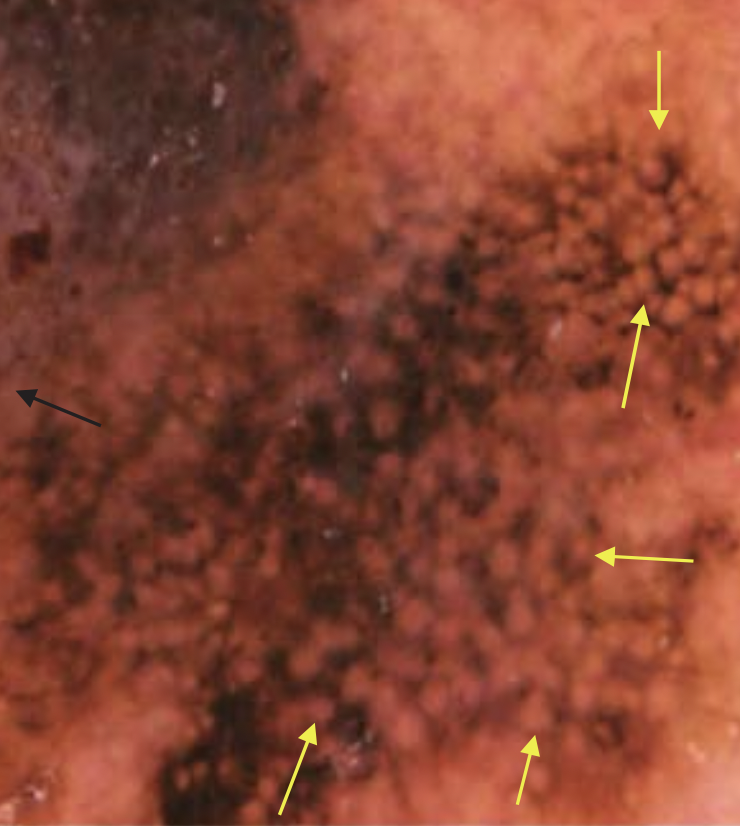 DermMarianne's tweet photo. 1⃣ Dermoscopic structure a day
⭕️ Asymmetrical follicular pigmentation: irregular brown pigmentation outlining parts of the round follicular openings
Classically seen in lentigo maligna
#dailyscope https://t.co/glzh6RJF7R