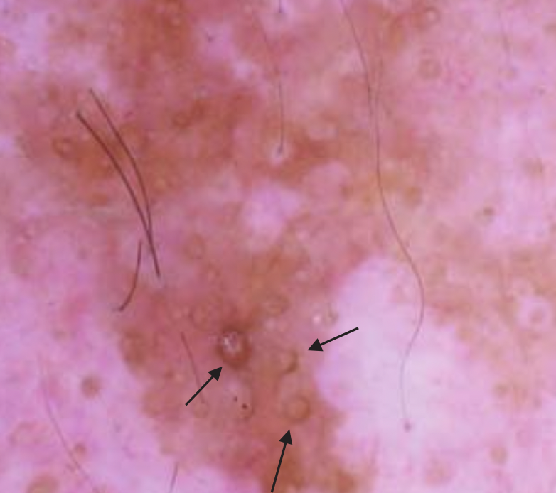 DermMarianne's tweet photo. 1⃣ Dermoscopic structure a day
⭕️ Asymmetrical follicular pigmentation: irregular brown pigmentation outlining parts of the round follicular openings
Classically seen in lentigo maligna
#dailyscope https://t.co/glzh6RJF7R