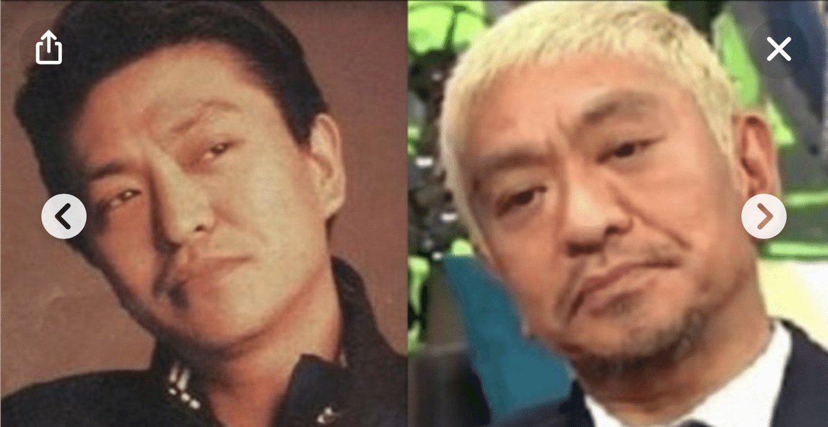 billionere123's tweet photo. 加齢で鼻が大きくなる原因は主に３つあって
①支持性が弱くなる
若い頃は鼻先は軟骨と靭帯でピンと支えられていますが加齢とともに大鼻翼軟骨と鼻中隔軟骨
そしてそれらを支える靭帯が緩みます。
② 骨の萎縮で土台が減る
加齢で顔の骨は少しずつ吸収されます。上顎骨（鼻の土台部分）が痩せるとその上に載っている鼻全体が低くなり垂れてくることで大きく見えます。
③ 皮膚と皮下組織が厚くなり、たるむ
加齢で皮脂腺が肥大しやすくなる（特に男性の鼻先）