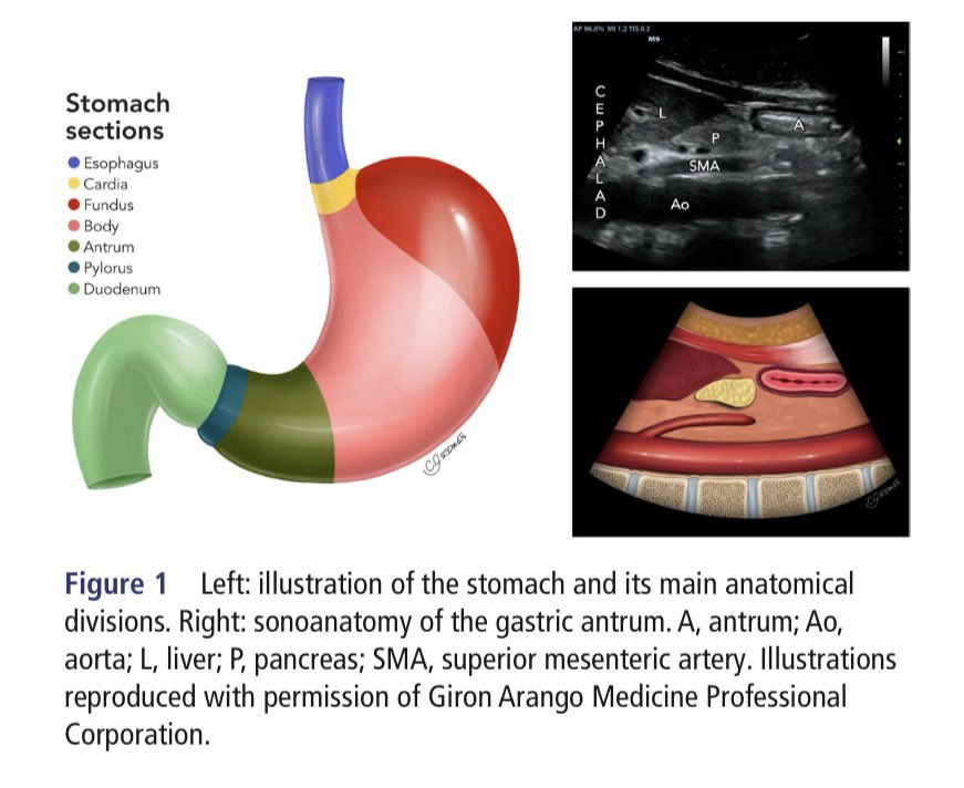 EmergPOCUS's tweet photo. 🫃🫀 #Ultrasonido del antro gástrico: lo esencial paso a paso 🚶🏽‍♂️ #ExhoCaps

📌 #Anatomía gástrica básica
🍽️ El estómago se divide en: cardias, fondo, cuerpo, antro y píloro.
🔍 En ecografía, el antro gástrico es la referencia clave para la valoración del contenido gástrico.

📍 #Sonoanatomía del antro
🧠 El antro se identifica anterior a la aorta,
🫀 en íntima relación con el hígado,
🥑 el páncreas y la arteria mesentérica superior.

📐 #Posición del transductor
🛏️ Decúbito supino
🔄 Decúbito lateral derecho
👉 Estas posiciones facilitan la visualización y aumentan la sensibilidad para detectar contenido gástrico.

👁️ Cómo se ve un antro vacío 
🎯 Forma de “ojo de buey” profunda al borde hepático
📏 Plano, delgado y colapsado
🧍‍♂️ Puede variar en pacientes con obesidad
💧 Puede observarse una mínima cantidad de líquido claro sin significado patológico

🧱 Pared gástrica en ultrasonido
📚 Patrón multilaminar característico🤓:
1️⃣ Serosa
2️⃣ Muscular propia
3️⃣ Submucosa
4️⃣ Muscular de la mucosa
5️⃣ Interfase aire-mucosa

📢 #POCUS gástrico sencillo en concepto, pero un poco más complejo en la práctica y tu que opinas ?🚑📡

Cheng P, et al. Reg Anesth Pain Med 2026;0:1–5. doi:10.1136/rapm-2025-107362