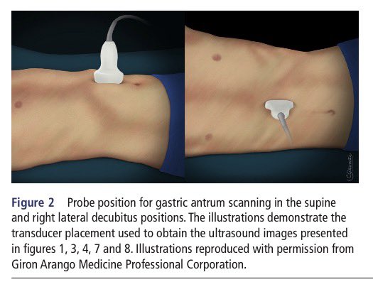 EmergPOCUS's tweet photo. 🫃🫀 #Ultrasonido del antro gástrico: lo esencial paso a paso 🚶🏽‍♂️ #ExhoCaps

📌 #Anatomía gástrica básica
🍽️ El estómago se divide en: cardias, fondo, cuerpo, antro y píloro.
🔍 En ecografía, el antro gástrico es la referencia clave para la valoración del contenido gástrico.

📍 #Sonoanatomía del antro
🧠 El antro se identifica anterior a la aorta,
🫀 en íntima relación con el hígado,
🥑 el páncreas y la arteria mesentérica superior.

📐 #Posición del transductor
🛏️ Decúbito supino
🔄 Decúbito lateral derecho
👉 Estas posiciones facilitan la visualización y aumentan la sensibilidad para detectar contenido gástrico.

👁️ Cómo se ve un antro vacío 
🎯 Forma de “ojo de buey” profunda al borde hepático
📏 Plano, delgado y colapsado
🧍‍♂️ Puede variar en pacientes con obesidad
💧 Puede observarse una mínima cantidad de líquido claro sin significado patológico

🧱 Pared gástrica en ultrasonido
📚 Patrón multilaminar característico🤓:
1️⃣ Serosa
2️⃣ Muscular propia
3️⃣ Submucosa
4️⃣ Muscular de la mucosa
5️⃣ Interfase aire-mucosa

📢 #POCUS gástrico sencillo en concepto, pero un poco más complejo en la práctica y tu que opinas ?🚑📡

Cheng P, et al. Reg Anesth Pain Med 2026;0:1–5. doi:10.1136/rapm-2025-107362