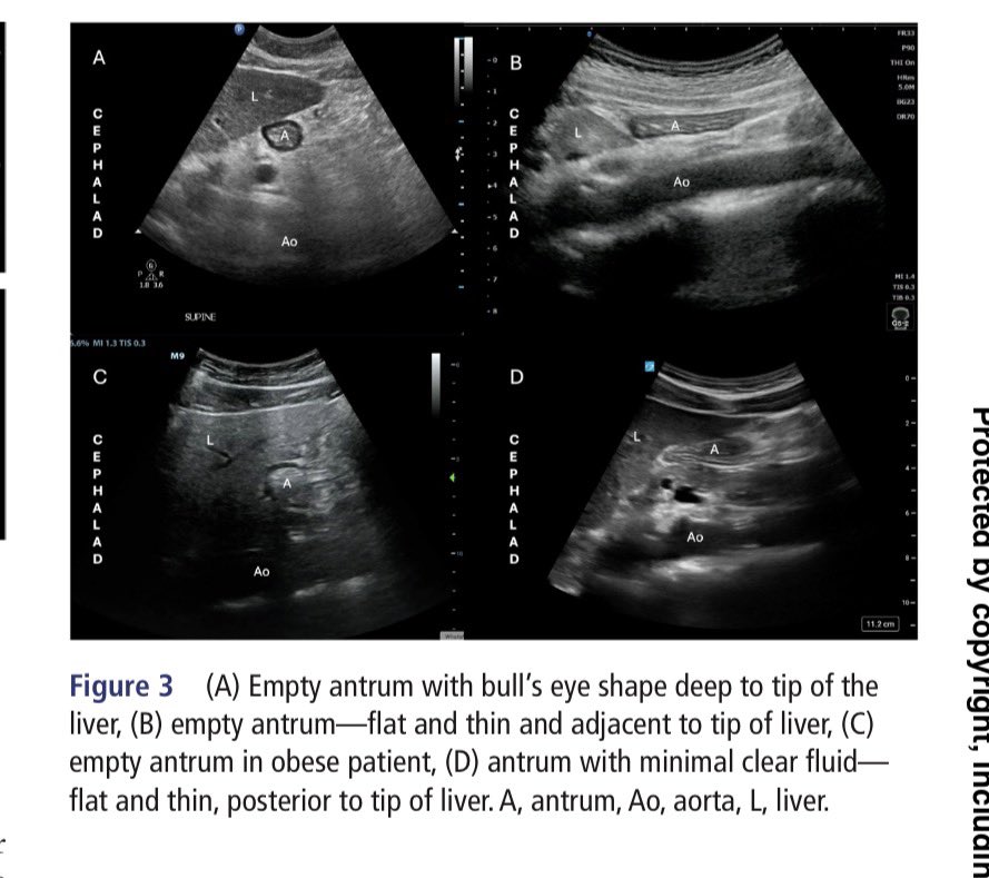 EmergPOCUS's tweet photo. 🫃🫀 #Ultrasonido del antro gástrico: lo esencial paso a paso 🚶🏽‍♂️ #ExhoCaps

📌 #Anatomía gástrica básica
🍽️ El estómago se divide en: cardias, fondo, cuerpo, antro y píloro.
🔍 En ecografía, el antro gástrico es la referencia clave para la valoración del contenido gástrico.

📍 #Sonoanatomía del antro
🧠 El antro se identifica anterior a la aorta,
🫀 en íntima relación con el hígado,
🥑 el páncreas y la arteria mesentérica superior.

📐 #Posición del transductor
🛏️ Decúbito supino
🔄 Decúbito lateral derecho
👉 Estas posiciones facilitan la visualización y aumentan la sensibilidad para detectar contenido gástrico.

👁️ Cómo se ve un antro vacío 
🎯 Forma de “ojo de buey” profunda al borde hepático
📏 Plano, delgado y colapsado
🧍‍♂️ Puede variar en pacientes con obesidad
💧 Puede observarse una mínima cantidad de líquido claro sin significado patológico

🧱 Pared gástrica en ultrasonido
📚 Patrón multilaminar característico🤓:
1️⃣ Serosa
2️⃣ Muscular propia
3️⃣ Submucosa
4️⃣ Muscular de la mucosa
5️⃣ Interfase aire-mucosa

📢 #POCUS gástrico sencillo en concepto, pero un poco más complejo en la práctica y tu que opinas ?🚑📡

Cheng P, et al. Reg Anesth Pain Med 2026;0:1–5. doi:10.1136/rapm-2025-107362