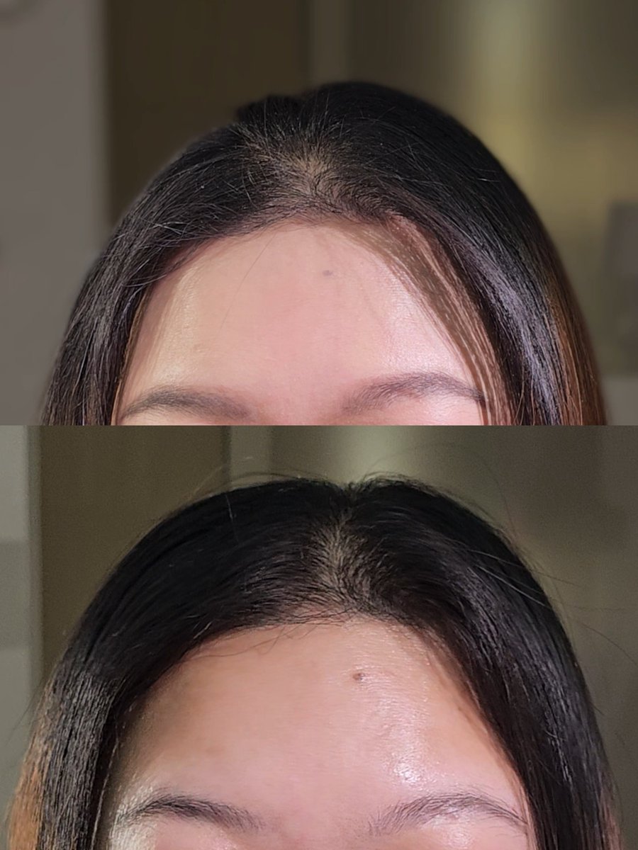 ผมกลับมาหนาแน่นขึ้นจริงอ่ะ กินมาต่อเนื่อง AHP Heratin ตอนนี้ถ่ายรูปแล้วผมดูเยอะขึ้น ไม่ขาวเป็นวงแล้ว จากก่อนหน้านี้ถ่ายรูปออกมาเห็นหนังหัวขาวๆ ขนาดหวีช่วยแล้วเป็นวงกว้างเลย ดูหัวล้านมาก ใครผมร่วงเยอะๆ ลองดูได้ นี่เห็นผลจริงคุ้มเงินที่จ่ายมาก