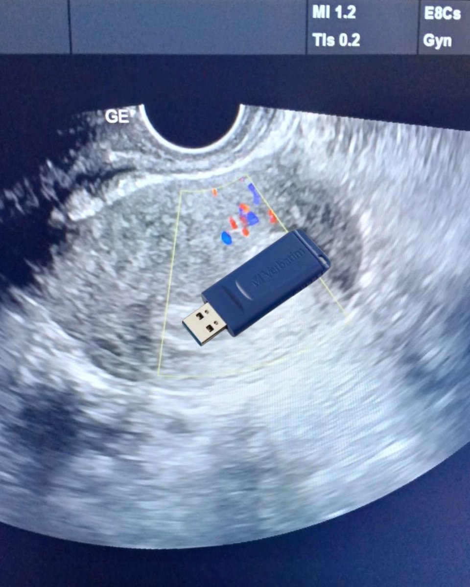 sunshineholi's tweet photo. This is Emily’s ultrasound as she lovingly awaits her baby with Vincent 💙📺 + 🪽🩵= 💻👼🏽

😂😂😂😂😂😂😂😂😂
#statichalo #humor
 #HazbinHotel #emily #Vincent https://t.co/I1FZRKiqAi