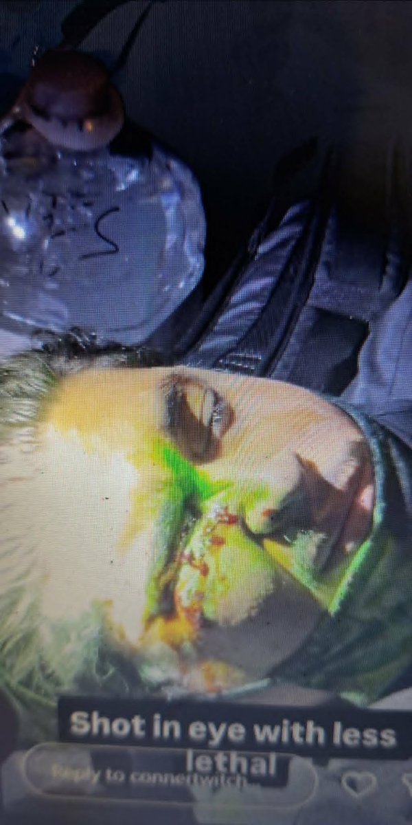 crewesmedia's tweet photo. Shot in the eye with less lethal @connertwitch #laprotest https://t.co/Jc6wdRgOBy