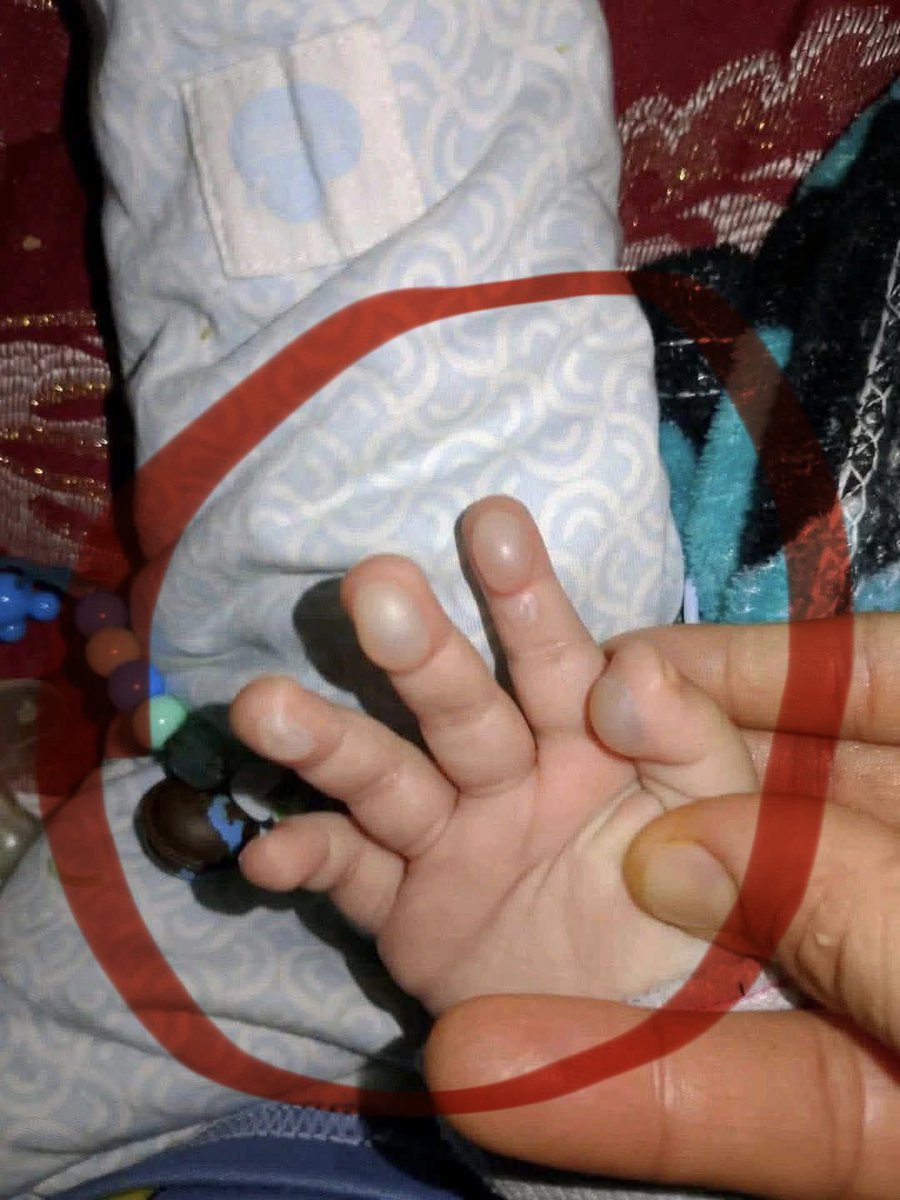 Dr_SaebGaza's tweet image. My sister suffered burns on her hand due to the open fire I was using for cooking. Therefore, I kindly ask for your help in purchasing a cooking gas stove so we can avoid using open flames and prevent her from getting hurt again.”😭🤍💔💔💔😫😫😫😫😫😫💔 gofund.me/62fb9062d