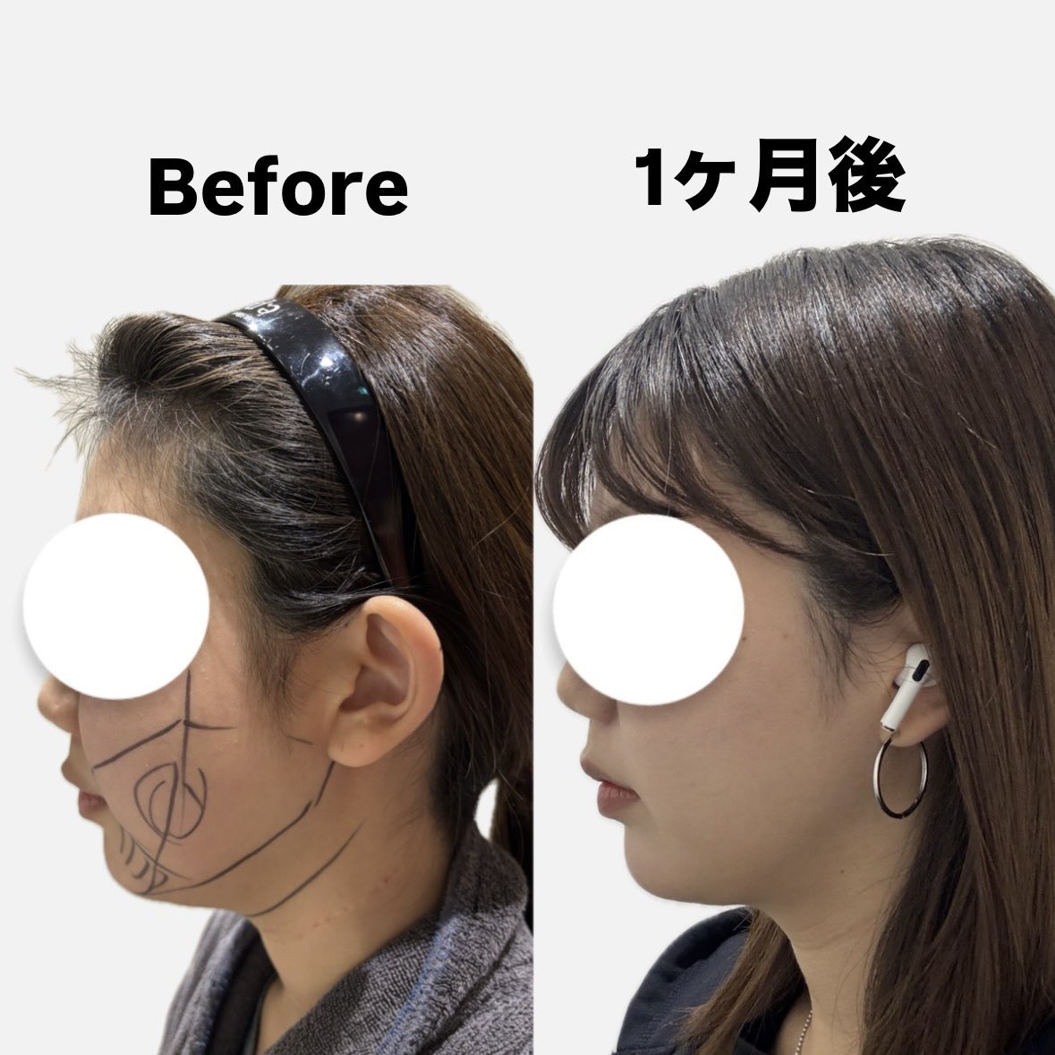 ymst____00's tweet photo. オンユで脂肪吸引とSMASリフトしてから1ヶ月が経ちました！

腫れも気にならなくなり、快適に過ごせてます！
食事やカリウム摂取など浮腫まないようにきをつけることも大事なダウンタイムの過ごし方な気がする💭

顔がちっちゃくなったとか、垢抜けた？と言われることもあり��しい🍀

@onyoops_jp https://t.co/XcrZKZcsHp