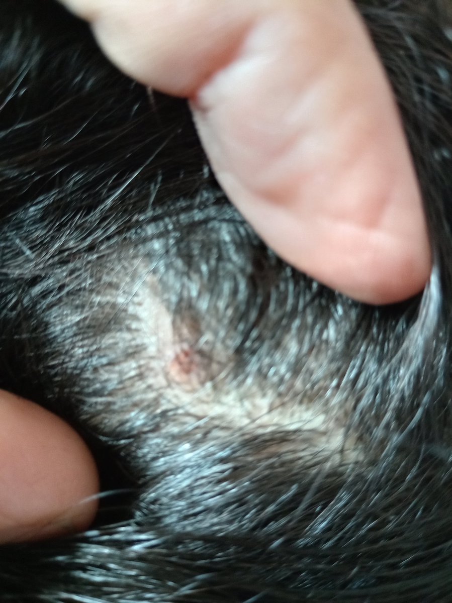 DalulainGaza's tweet image. A bacterial infection has spread in my poor daughter's hair, and her hair is falling out profusely. 
😭😭🙏
Please help me so I can buy the necessary treatment for her. Please, I don't want her to lose her hair. 
💔
chuffed.org/project/138194…