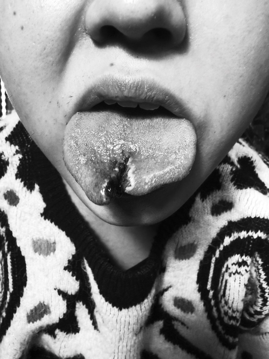 96Olver_pf's tweet photo. スプリットタン
#スプリットタン
#蛇舌
#painfactory https://t.co/DybhyU5qeb