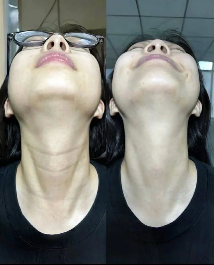 yqounger's tweet image. solusi buat hapus garis-garis leher yang mengganggu. kulit leher mulus, lebih kencang dan halus