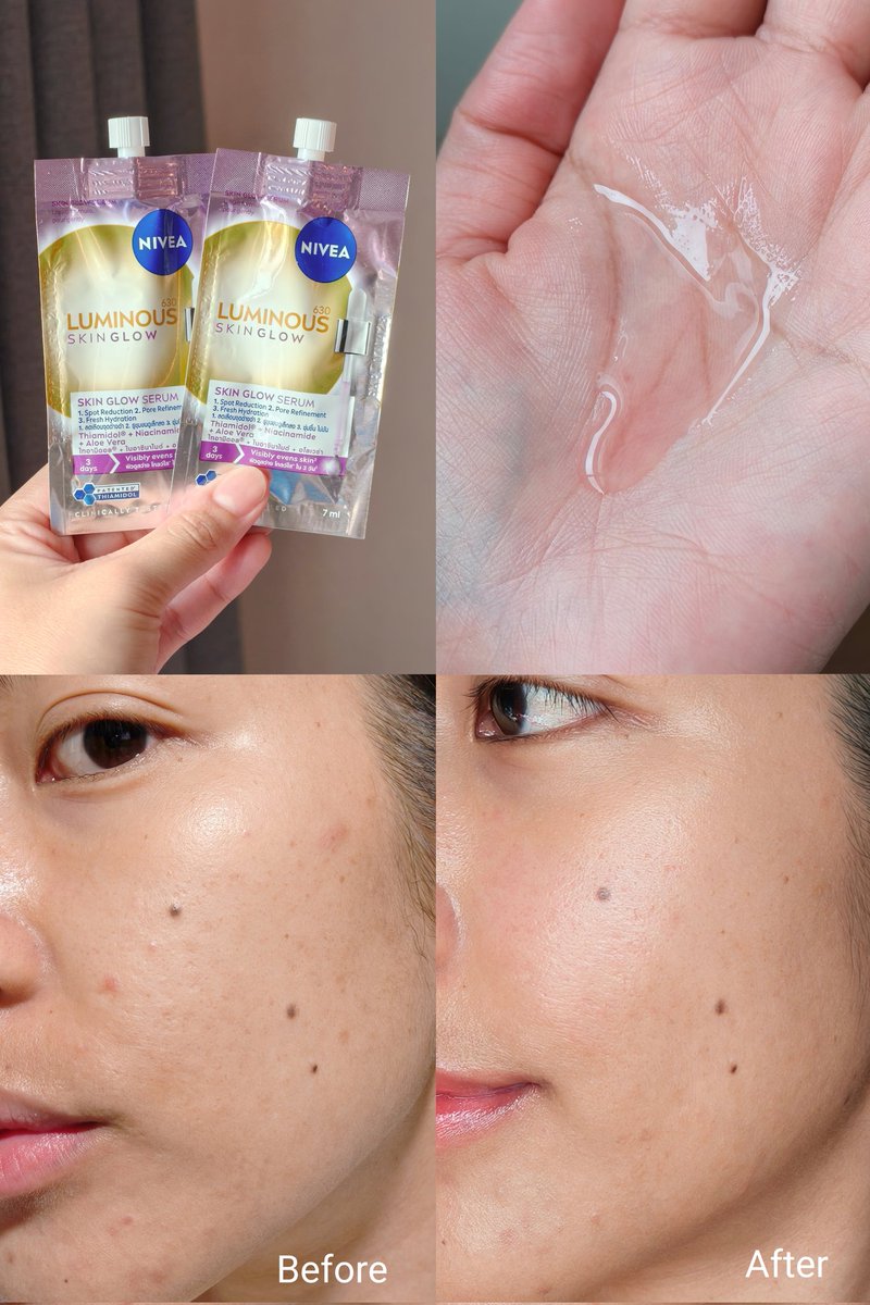 อีกหนึ่งเซรั่มที่ลดจุดดำ รอยสิวดีมาก จางไว จางจริง NIVEA Skin Glow Serum มีไทอามิดอล สารไบรท์เทนนิ่งที่ดีที่สุด ที่ช่วยลดจุดด่างดำฝังลึกถึงต้นตอ และลดการเกิดจุดด่างดำใหม่ๆ เก่งกว่าวิตซี 60 เท่าเลย เห็นผลแน่นอนว่ารอยจางไว ผิวโดยรวมสว่างใสขึ้นด้วย เนื้อเซรั่มเหมือนน้ำ เบาสบาย