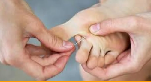 الشظايا تحت الجلد.. كيف يمكن علاجها في المنزل؟ 