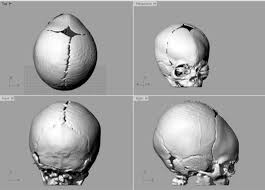 Lab3dHulp's tweet photo. 🧩Un sistema impreso en #3D permite «silenciar» genes responsables de malformaciones craneales, vía @3Dnatives_ES
⚓️https://t.co/gjByVe9iZP
#Lab3DHulp #MAXILOLAPAZ #Bioimpresion3D #FabricacionAditiva #CirugíaNavegada #IA #ComputaciónCuántica #RealidadAumentada #Algoritmos https://t.co/BGcQYNX68v