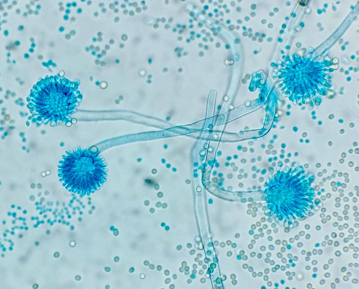 gemicomed's tweet photo. 🦠 Invisible en el aire. Crítico en pacientes vulnerables
Hoy es el Día Mundial de la #Aspergilosis
La aspergilosis invasiva se asocia a elevada mortalidad, por lo que el diagnóstico precoz y el tratamiento antifúngico son determinantes‼️
#WorldAspergillosisDay https://t.co/H1Vxz2Rtr9