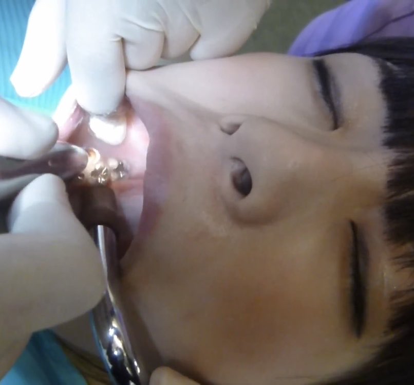Intraoral_TX's tweet photo. こんばん歯〜また皆さん如何お過ごしでしょうか？割りかし歯科医院が休診日の毎週は木曜にリリース予定です。続いて今月に素晴らしい発表がございます🦷

#歯科治療 #口腔 #虫歯 https://t.co/3G5WFHBHeZ