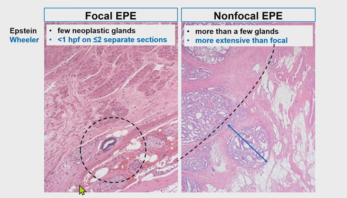 Prostate Cancer Staging  
pT3a Extraprostatic Extension  

- Tumor beyond the confines of the gland, admixed with or bulging beyond periprostatic adipose tissue  
- Extent should be documented  

Dr. Magi-Galluzzi - 2025 Diagnostic Pathology Update #USCAP #PathX #PathTwitter