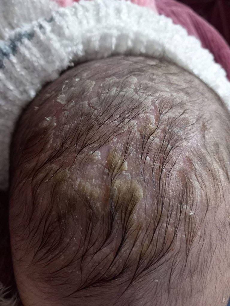 Dr_SaebGaza's tweet image. This thing has started appearing on my little sister's head and I'm very worried about her. Whoever knows the solution, please tell me. 😭

gofund.me/62fb9062d