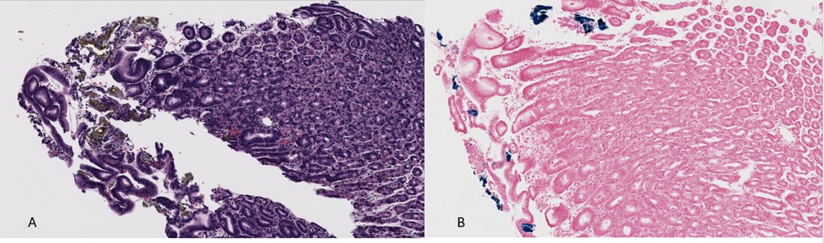 JPGNonline's tweet photo. Case image 📸
Teen with anemia + GI symptoms
Unexpected gastric lesion on EGD
Common treatment… uncommon finding
What’s the diagnosis?
🔗 https://t.co/fk38yDf0hQ
#pediatrics #pedsgi #caseimage #endoscopy https://t.co/oHYTINSkwy