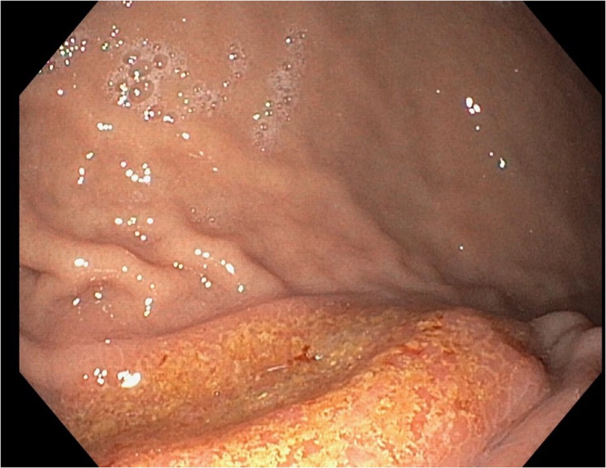 JPGNonline's tweet photo. Case image 📸
Teen with anemia + GI symptoms
Unexpected gastric lesion on EGD
Common treatment… uncommon finding
What’s the diagnosis?
🔗 https://t.co/fk38yDf0hQ
#pediatrics #pedsgi #caseimage #endoscopy https://t.co/oHYTINSkwy