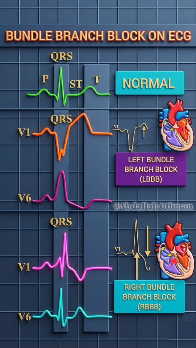 CardioBeat_'s tweet photo. https://t.co/4atkYEyWq2

Bundle Branch Blocks: LBBB shows broad QRS (>120ms) with monophasic R waves in V6. 
RBBB features rsR' in V1 and wide S waves laterally. Both indicate delayed ventricular depolarization, requiring clinical correlation. 
#Cardiology #ECG #LBBB  #RBBB https://t.co/4p3WzsXBHK