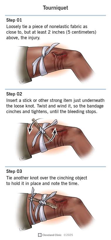 SavvyRinu's tweet photo. @SaintHambruz @Udee_Faith First image is splinting. Second image is tying https://t.co/Fp9bERXfKR