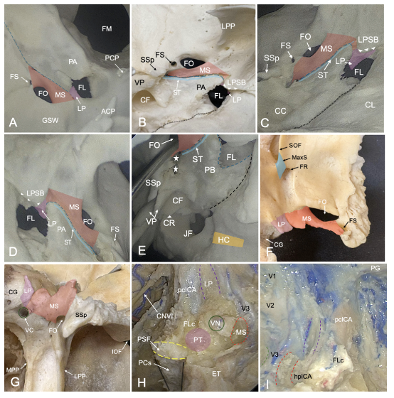 TheJNS's tweet image. #OnlineFirst: The mandibular strut and inferior petrous carotid triangle as key landmarks for endoscopic endonasal localization of the parapharyngeal internal carotid artery. 

thejns.org/view/journals/….