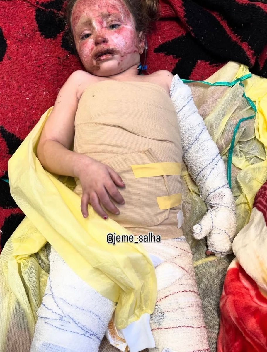 A victim of a quadcopter bomb. This is what the Israeli occupation does to innocent children in Gaza