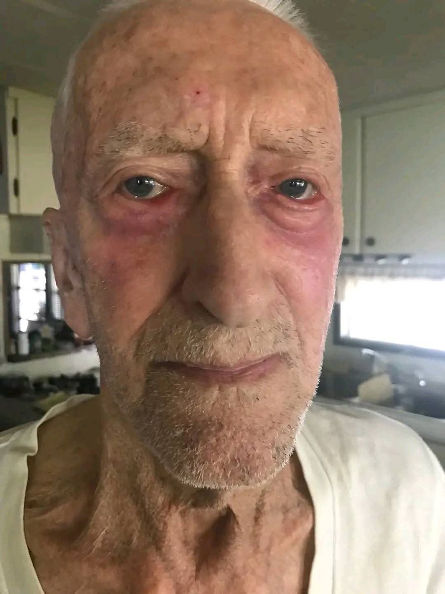 IVERMECTIN Topical Cream Testimonial - 88 year old Alberta farmer with  skin Cancer has 4 tubes of Ivermectin paste sent to him by his son

More and more Topical Ivermectin testimonials are starting to come in...

88 year old farmer in Alberta was diagnosed with skin cancer 

His