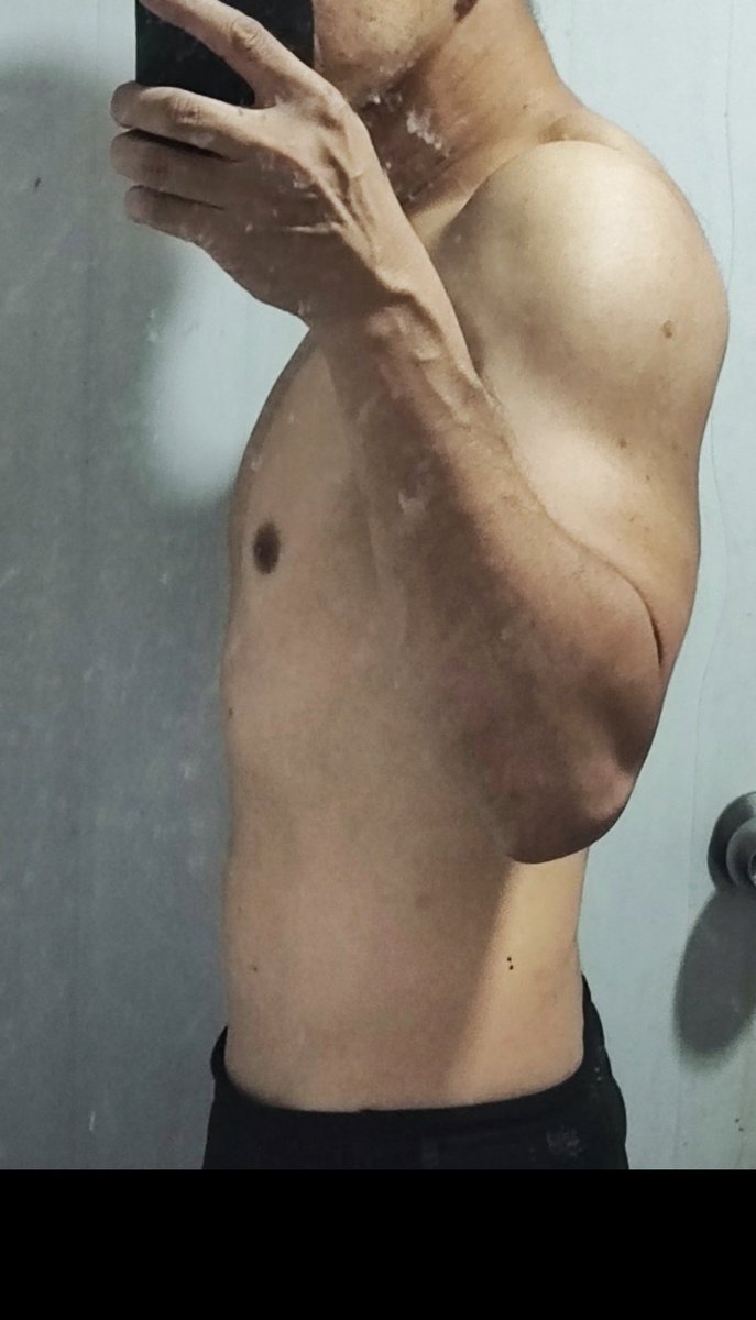 ตอน...พุงที่หายไป กับรอยคุ่นที่เต็มตัว