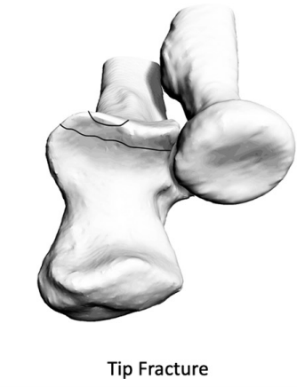 SportsMedReview's tweet image. Dr. Rubin looks at how to treat coronoid process fractures!

sportsmedreview.com/blog/coronoid-…

#MedicalEducation #MedEd #Physio #ATC #Orthopedics #SportsMedicine #PhysicalTherapy #AthleticTraining #Rehab #InjuryPrevention #SportsInjury #SportsRehab #PhysioTherapy #FOAMed
