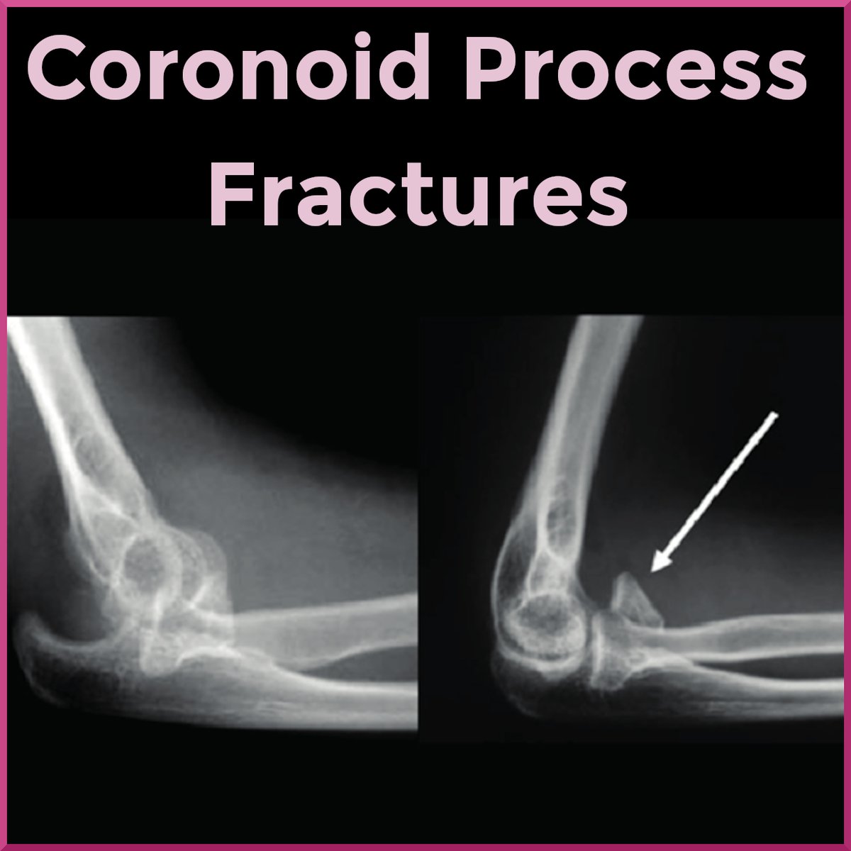 SportsMedReview's tweet image. Dr. Rubin looks at how to treat coronoid process fractures!

sportsmedreview.com/blog/coronoid-…

#MedicalEducation #MedEd #Physio #ATC #Orthopedics #SportsMedicine #PhysicalTherapy #AthleticTraining #Rehab #InjuryPrevention #SportsInjury #SportsRehab #PhysioTherapy #FOAMed