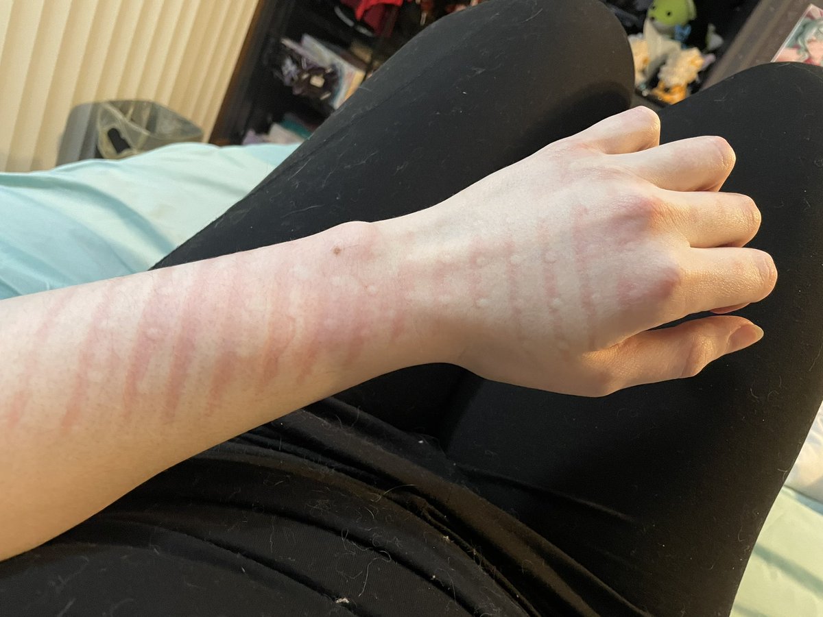 I accidentally layed with my arm under my heat pad behind my back for a bit too long and it looks so funny LOL I have stripes!!!