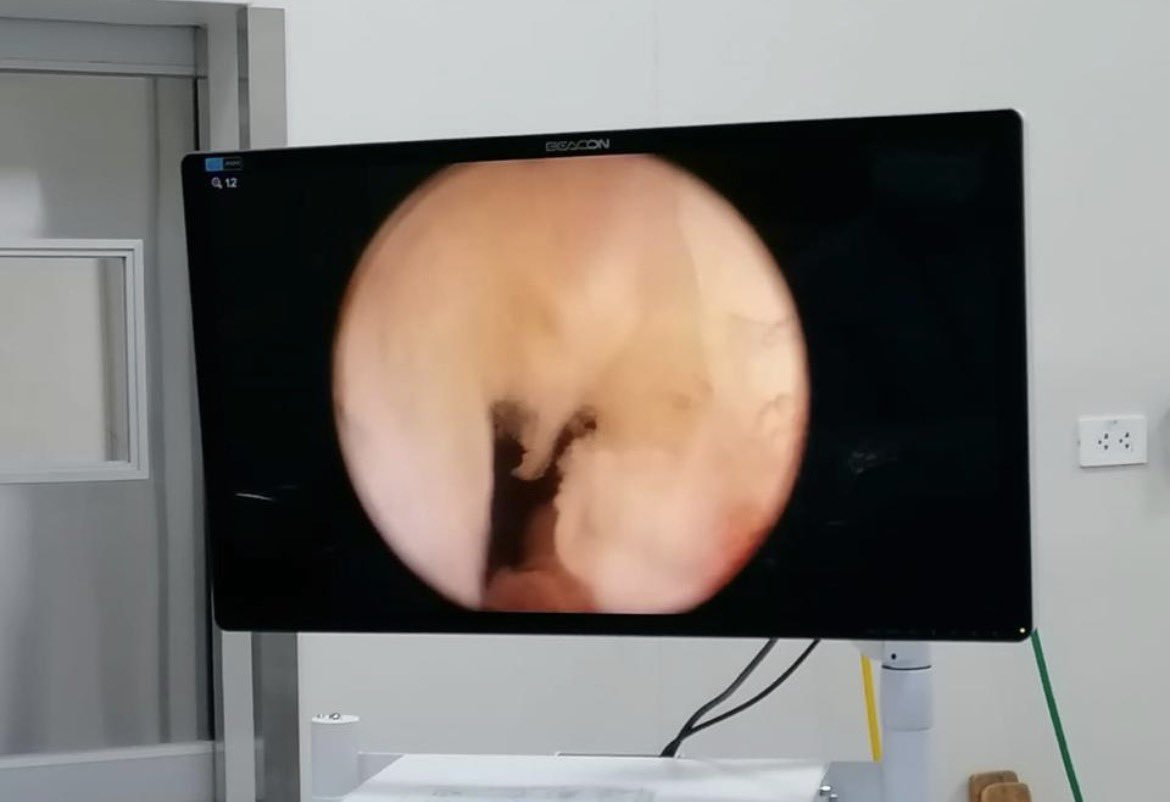DrSalirrosas's tweet photo. Uso de balón medicado con paclitaxel en la Estenosis de Cuello Vesical luego de la apertura con láser holmium, mayor uniformidad y durabilidad del tratamiento #elutax https://t.co/o544PeWBmQ