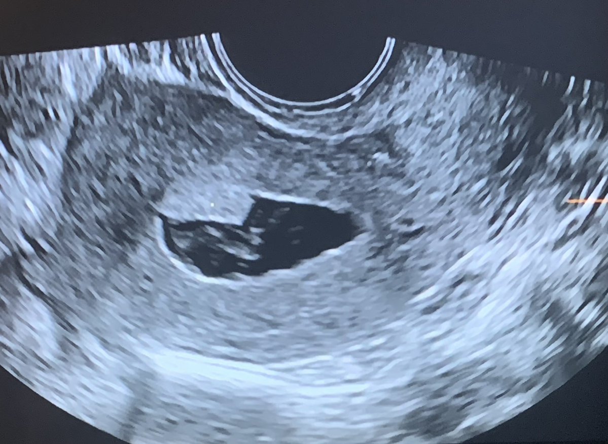 starsleeps's tweet image. My first OBGYN told me that my pain was just part of being a woman. Turns out I had uterine tumor so large that it took 2.5 hours in the operating room to remove it 🫠