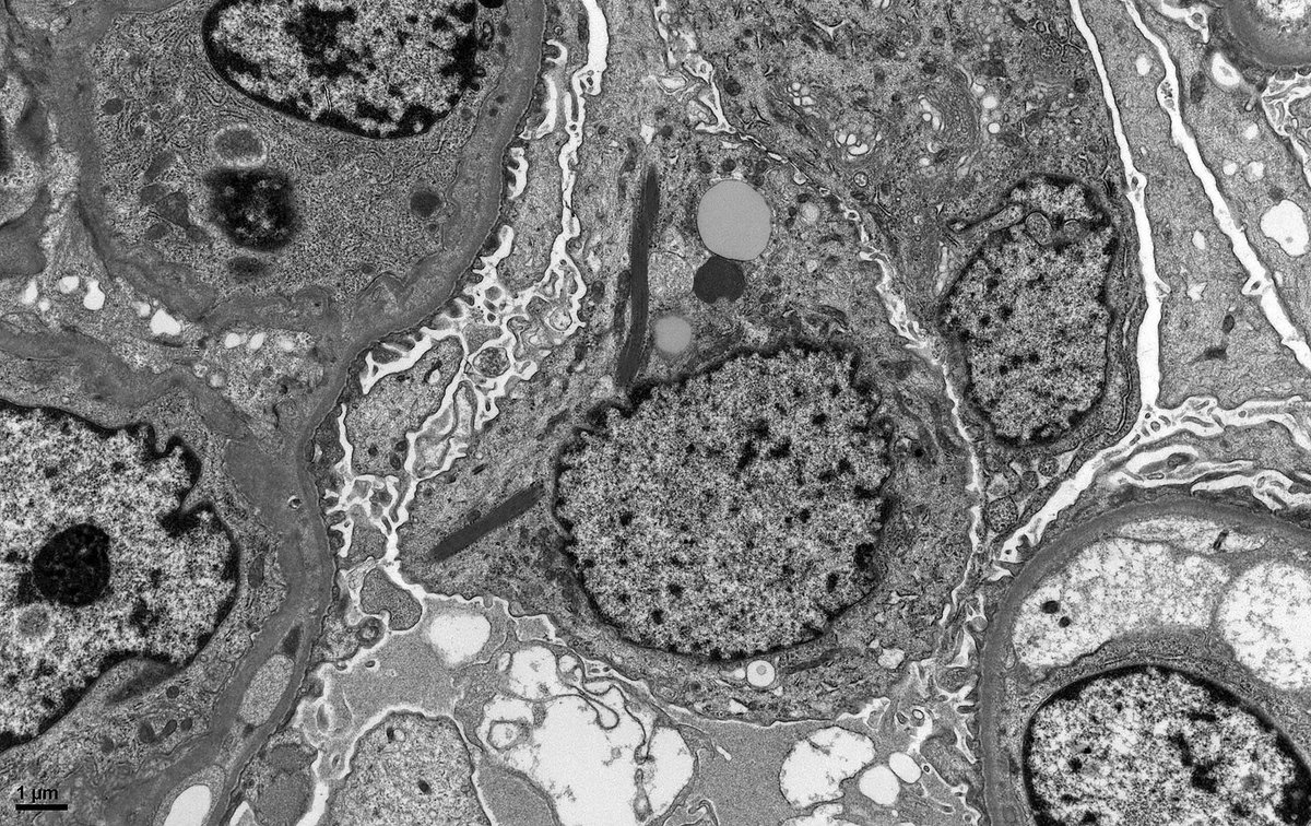 JohnBrealey's tweet photo. Another example of ribosome-lamella complexes within a podocyte from a case of transplant glomerulopathy. The significance of these structures is uncertain but possibly reflects aberrant protein sysnthesis within the cell. https://t.co/HmPmp9c4PA