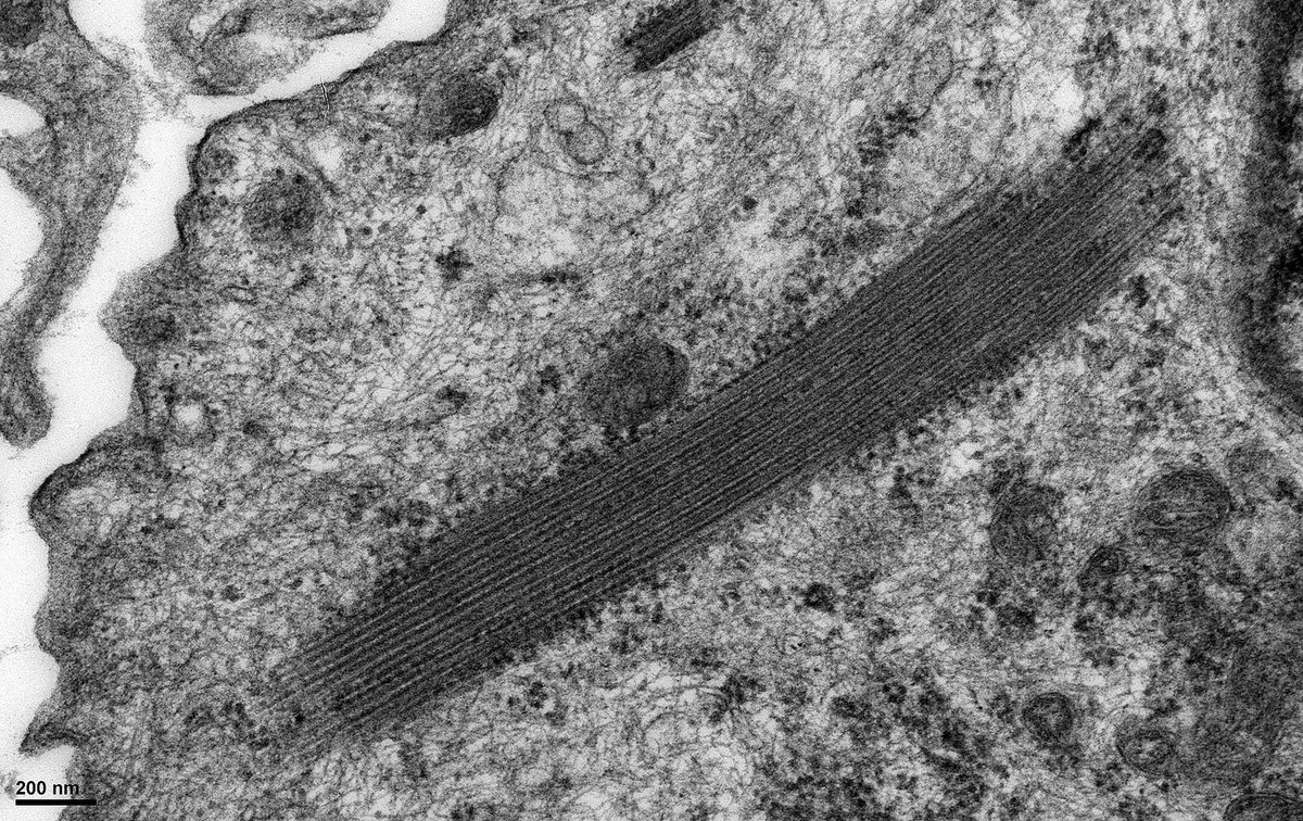 JohnBrealey's tweet photo. Another example of ribosome-lamella complexes within a podocyte from a case of transplant glomerulopathy. The significance of these structures is uncertain but possibly reflects aberrant protein sysnthesis within the cell. https://t.co/HmPmp9c4PA