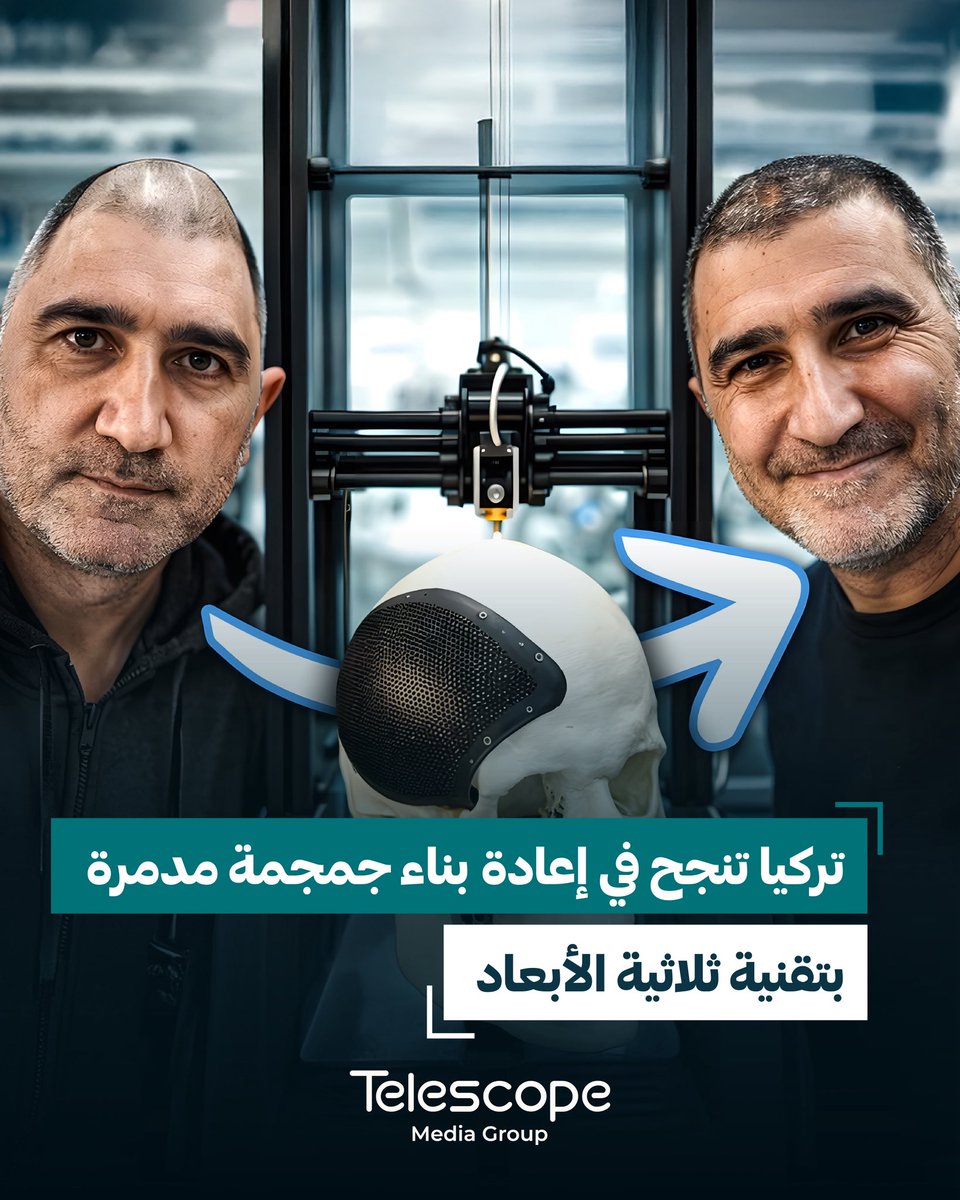 telescopemediag's tweet photo. في حالة طبية نادرة ومعقّدة، تعرّض مريض في تركيا لسقوط عنيف من الطابق الثالث، ما أدى إلى تحطّم أجزاء كبيرة من الجمجمة وح��وث إصابات خطيرة هددت حياته بشكل مباشر.

• السقوط تسبب في:
– كسور واسعة في عظام الجمجمة
– ضغط شديد على الدماغ
– خطر نزيف ومضاعفات عصبية
• مة؟ https://t.co/nJ84TsDDXd