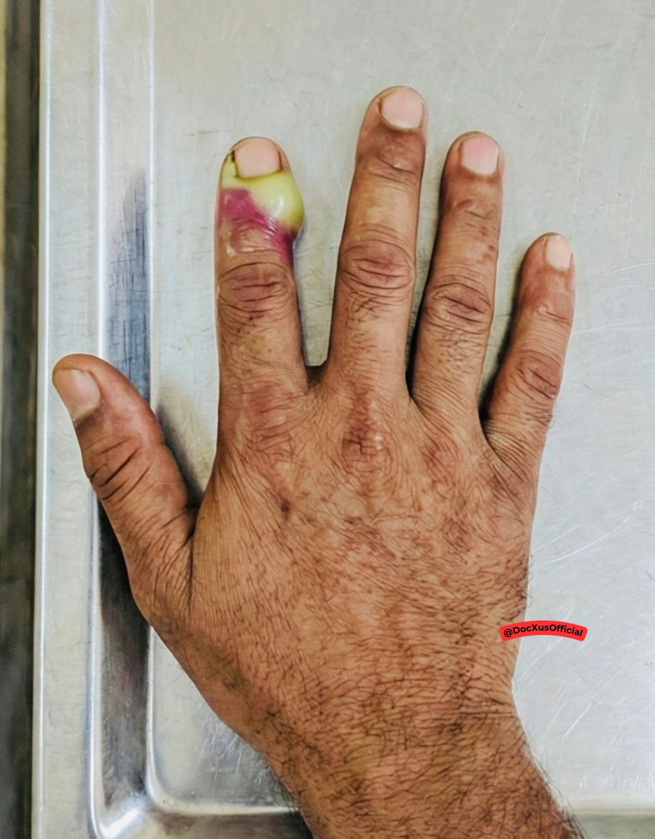 His finger became swollen and painful after NAIL BITING. 

Name this condition _______