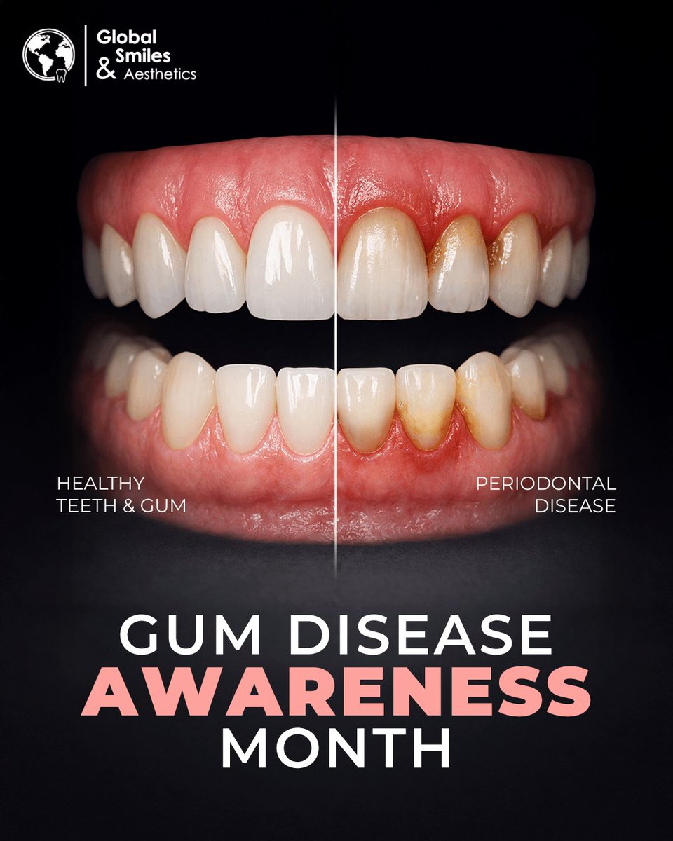 💙🦷 Gum Disease Awareness Month 🌿

Your #gums are the foundation of your #smile 😁.

Bleeding, swelling, or #BadBreath 🦷? These are signs to listen to 👂.

Show them extra #love ❤️
🪥 #Brush
🧵 #Floss
👨‍⚕️ Visit your #dentist

#HealthyGums = healthier you.

#Dental