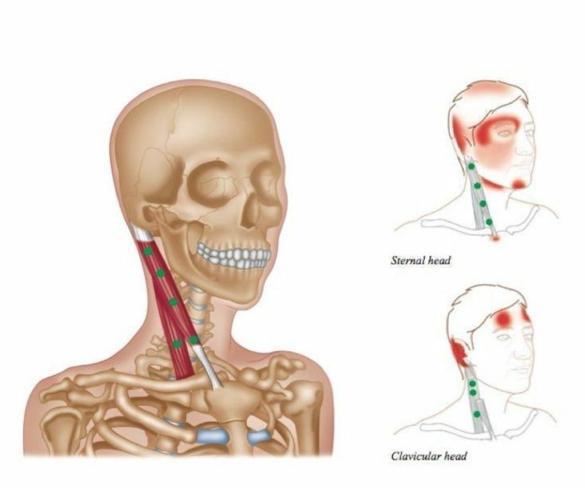 ptibra1's tweet photo. 📍 عضلة Sternocleidomastoid 

صورة توضّح أماكن العقد العضلية اللي ممكن تسبب صداع في الجبهة او حول العين 😣

🔹يلعب #العلاج_الطبيعي دور مهم ‼️
تحرير  العقد العضلية و الشد عن طريق تقنيات علاجية مثل :

◾️الابر الجافة
◾️العلاج اليدوي 
◾️التمارين العلاجية https://t.co/M3VmDTFOPF