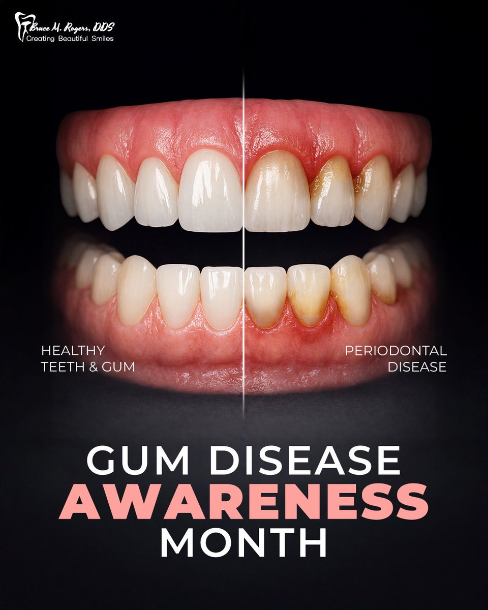 brucerogersdds's tweet photo. 💙🦷 Gum Disease Awareness Month 🌿

Your #gums are the foundation of your #smile 😁.

Bleeding, swelling, or #BadBreath 🦷? These are signs to listen to 👂.

Show them extra #love ❤️
🪥 #Brush
🧵 #Floss
👨‍⚕️ Visit your #dentist

#HealthyGums = healthier you.

#Dental https://t.co/7ydus1l5l9